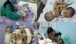 Nhật ký hành trình 'cộng sinh' của cặp song sinh dính liền tim, gan